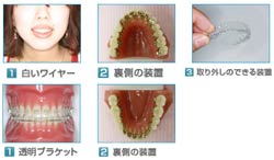 目立たない矯正