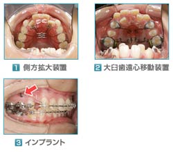 抜かない矯正