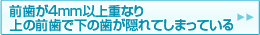 前歯が4mm以上重なり、上の前歯で、下の前歯がかくれてしまっている
